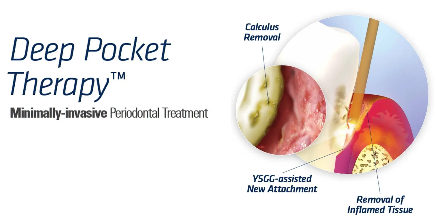 Graphic of Deep Pocket Treatment for tooth and gums